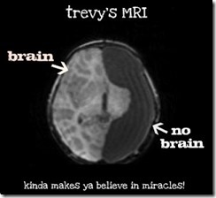 trevys MRI 